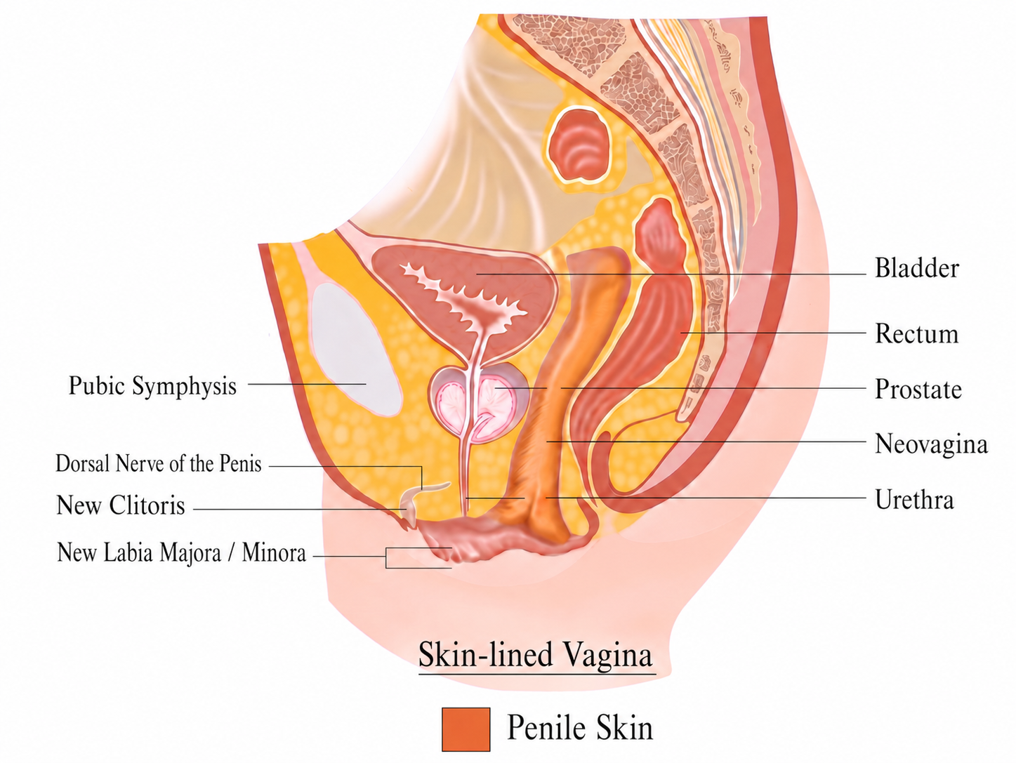 Postoperative neovagina diagram after penile inversion vaginoplasty, showing the neovagina, clitoris, labia, urethra, prostate, rectum, and bladder.