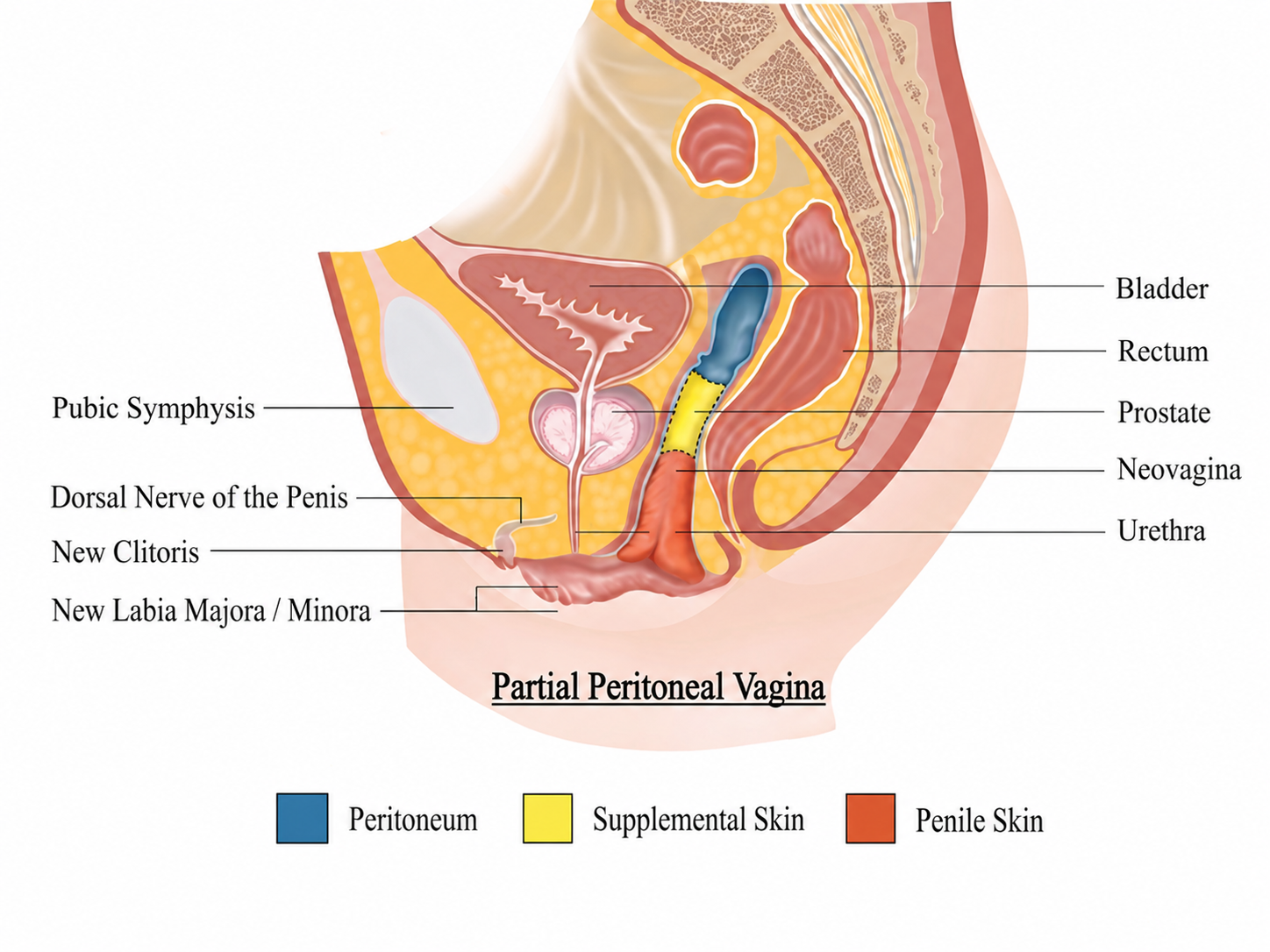 Postoperative neovagina diagram 1