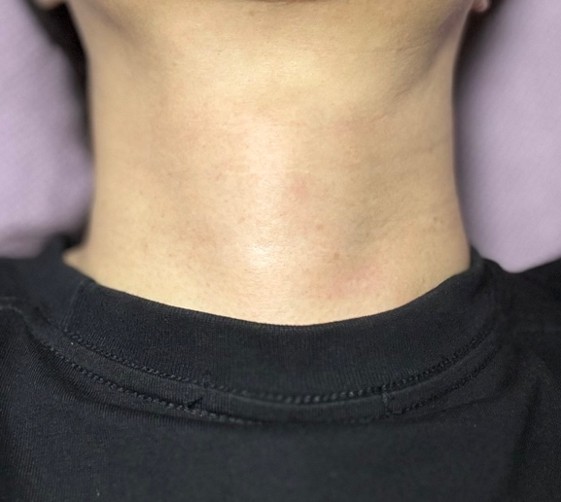 Close-up of a postoperative scar concealed within a natural neck crease