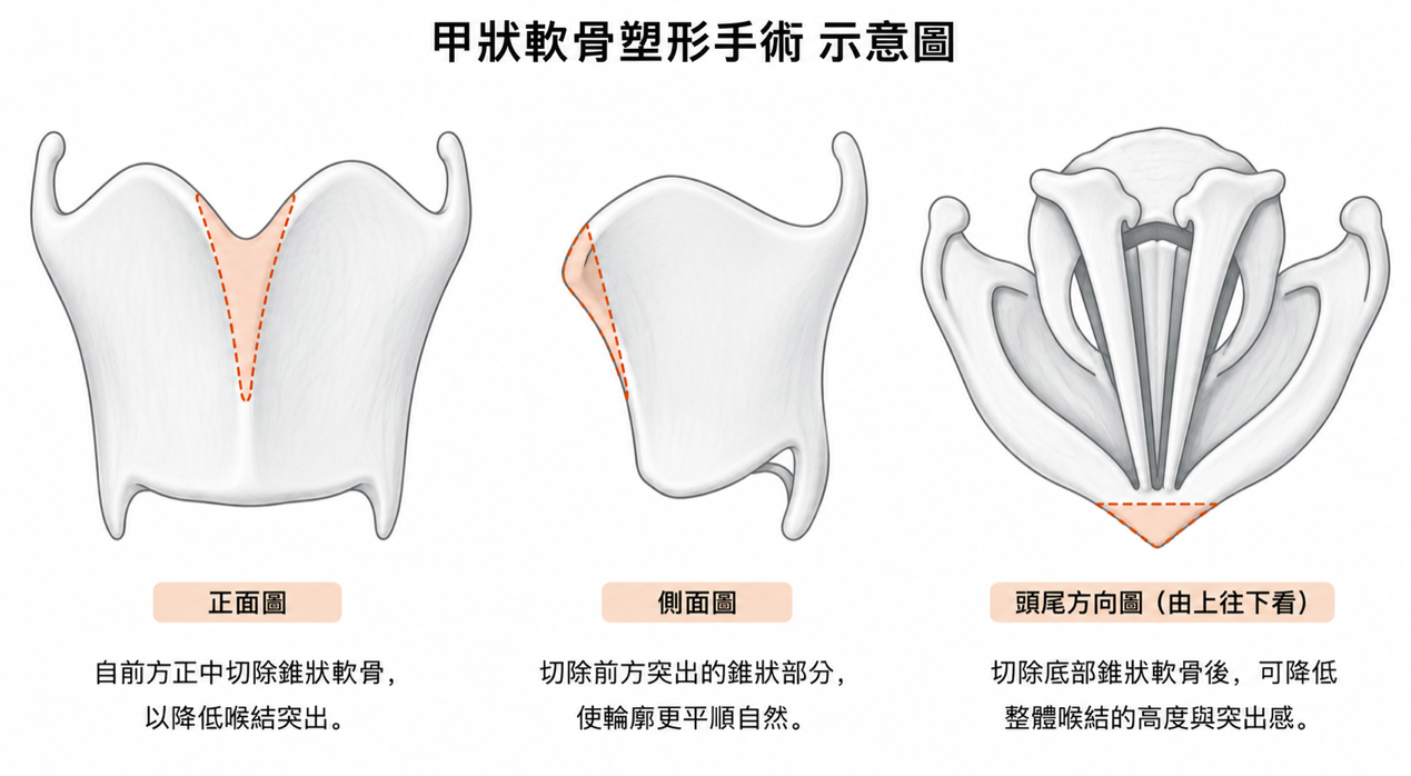 甲狀軟骨塑形手術示意圖,展示正面、側面與頭尾方向的修整範圍